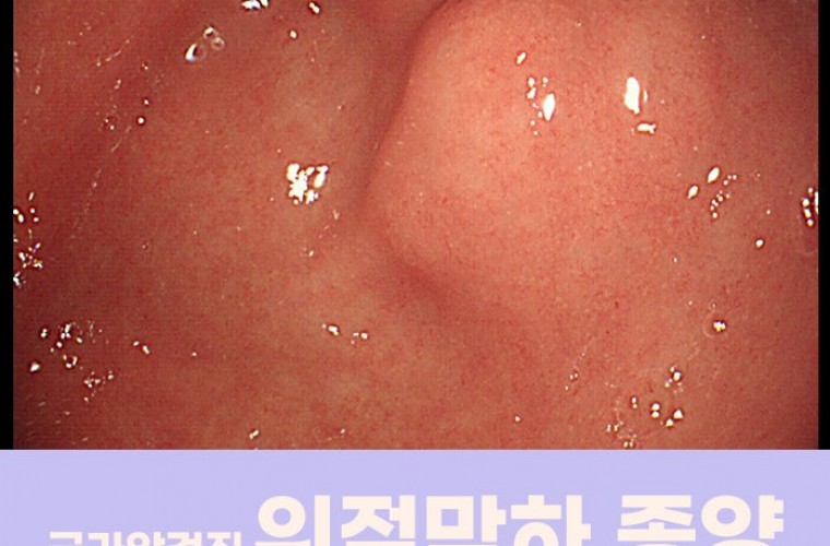 신림 건강검진센터, 정기적인 국가암검진으로 발견한 위점막하 종양 진단례